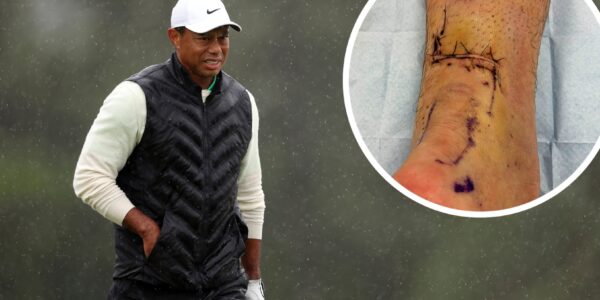 Update on Tiger Woods' injury: It may be until...2026.